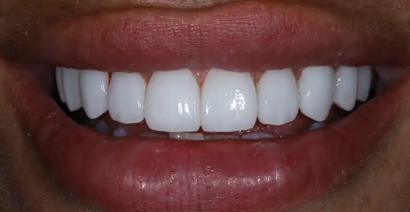 Free Smile Virtual Consult