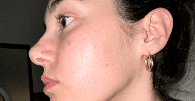 Acne Skincare Journey 🫧 (Celladix)