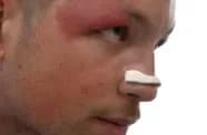 INTAKE NOSE STRIPS
