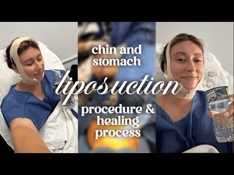 Liposuction Vlog!!