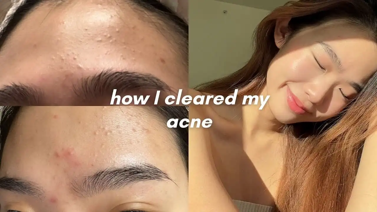YT: how I cleared my acne 
