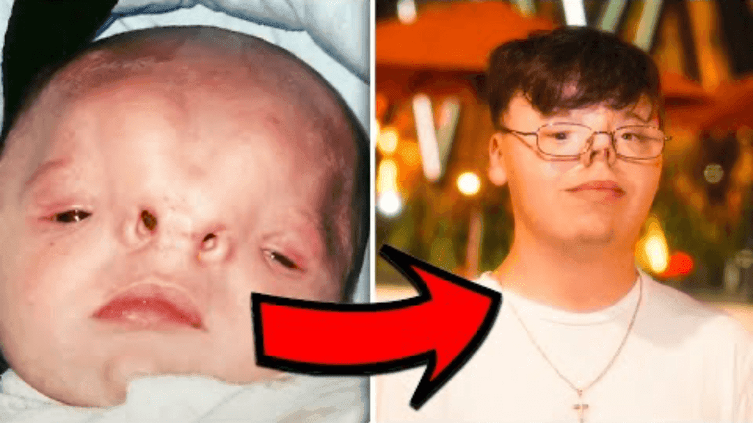 Frontal Nasal Dysplasia News Interview