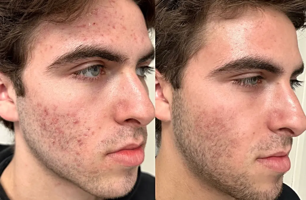 Acne Resources and Lifestyle Guides